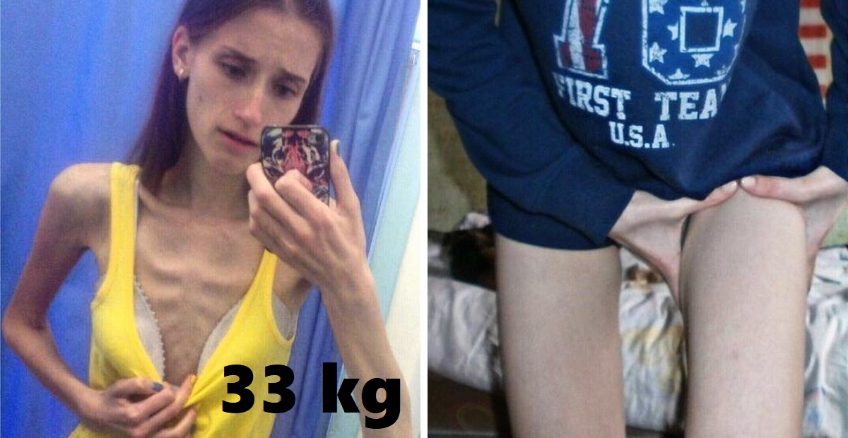 Mladá žena z Ruska trpela anorexiou, dnes je pre ženy s podobnými problémami veľkou inšpiráciou.