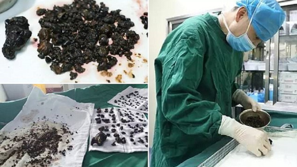 Lekári v Číne našli pacientke v tele 200 kameňov.