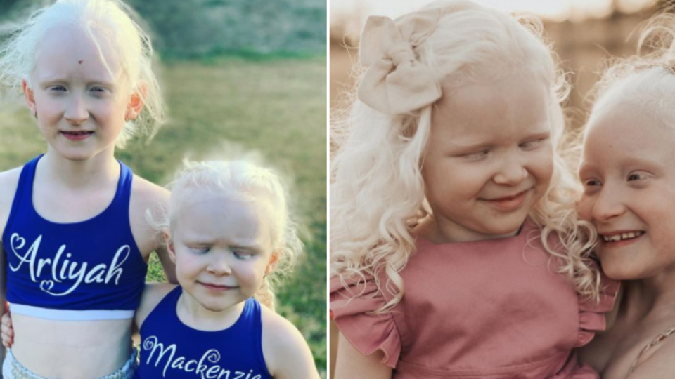 Arliyah a Mackanzie sa narodili s albinizmom a zrakovým postihnutím.
