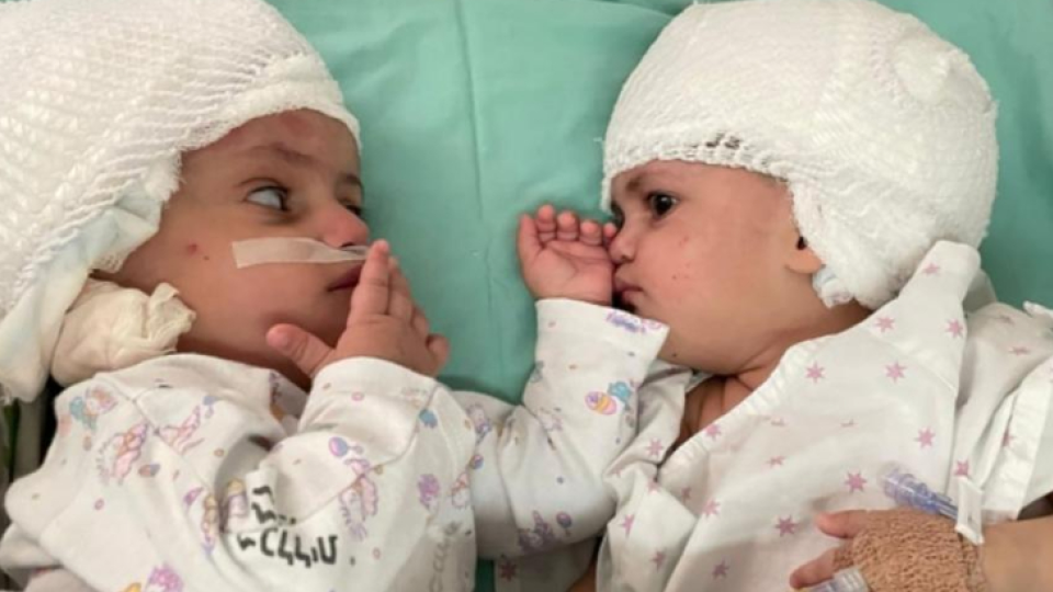 Siamské dvojičky sa po roku života uvideli prvýkrát tvárou v tvár.