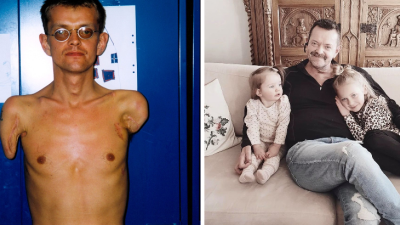 Ako prvý na svete podstúpil transplantáciu oboch rúk. Po rokoch dokázal prvýkrát objať svoje vnúčatá