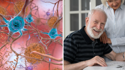 Prelom v liečbe Alzheimerovej choroby. Prvý liek v histórii dokáže bojovať proti strate pamäti u pacientov