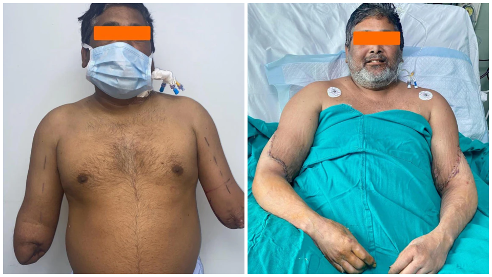 45-ročný Raj Kumar, ktorý podstúpil transplantáciu rúk.